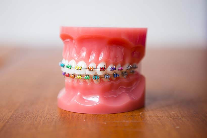 Stainless Steel (Metal) Braces Westside Orthodontics